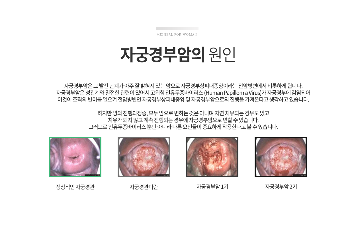 자궁경부암