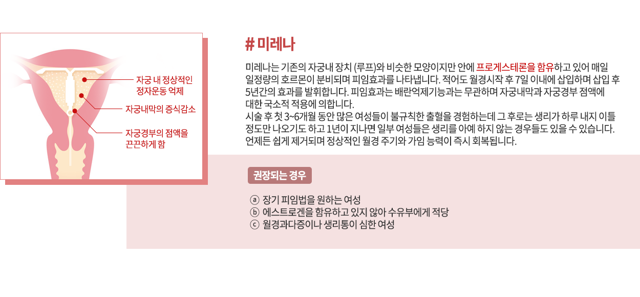 자궁내 장치 미레나