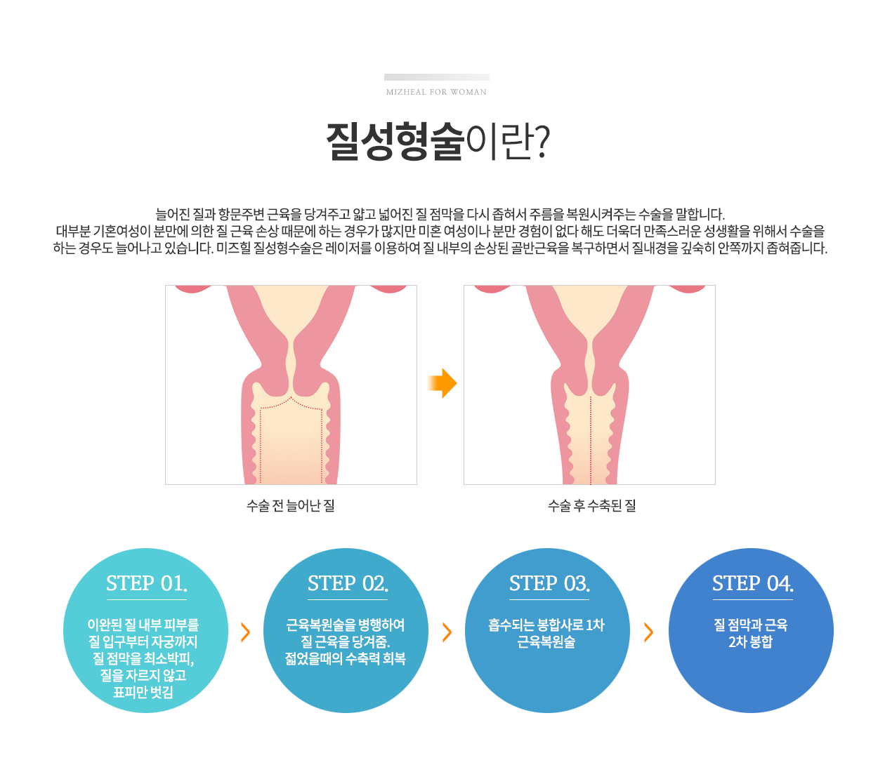 질성형수술이란